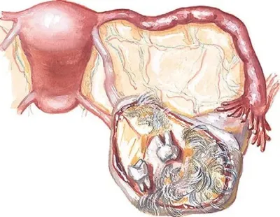 Дермоидная киста корня языка - DENTALMAGAZINE.RU