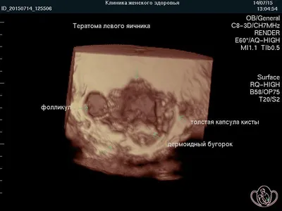 Дермоидная Киста Тератома Опухоль Которая Содержит Различные Твердые Ткани  Кожу стоковое фото ©katerynakon 606939998