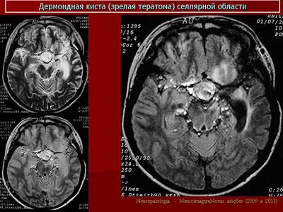 Диагностика дермоидных кист | Презентации Дерматовенерология | Docsity