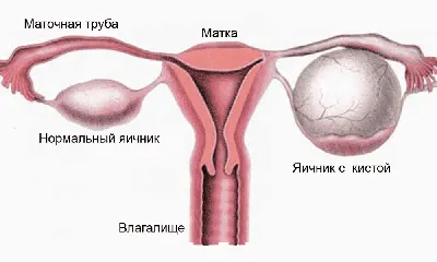 Киста Дермоидная? Геморрогическа? :: Вопрос врачу УЗИ - Расшифровка  результатов, консультация :: Форум - Для врачей УЗИ :: Uzgraph.ru -  мобильная версия