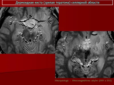 ГМ. Дермоидная киста (тератома). + | Портал радиологов