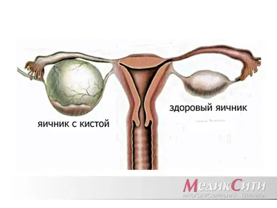 Дермоидная киста, тератома, цистаденома: ФОТО, лечение | Курортная клиника  женского здоровья