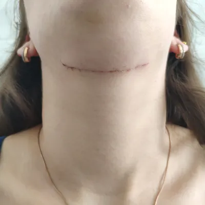 Дермоидная киста челюстно-лицевой области - диагностика и лечение в Москве.  Консультация врача.