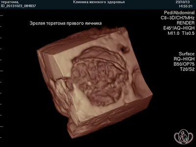 Как избавиться от дермоидной кисты в Киеве - Бізнес новини Покровська і  Мирнограда