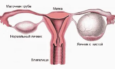 Дермоидная киста яичника – причины, симптомы, диагностика и лечение в  клинике «Будь Здоров»