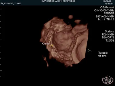 Киста яичника лечение, операция по удалению кисты яичника полостная,  лапароскопия кисты цена