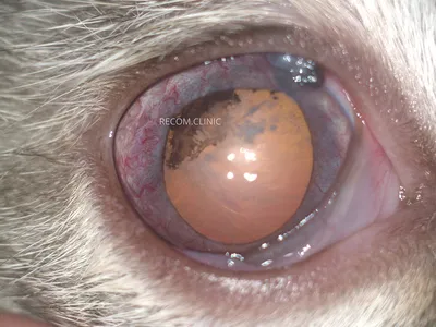Дермоидная киста глаза: диагностика, лечение
