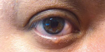 Офтальмология Тесты - ТЕСТЫ ПО ОФТАЛЬМОЛОГИИ Пациент с болями в области  глаза, сниженным зрением, - Studocu