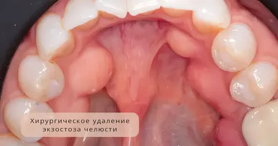 Гематома на десне у новорождённых во время прорезывания зубов.Она опасна? -  YouTube