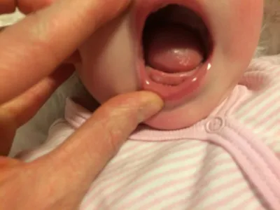 Подрезание уздечки языка новорожденному – статьи детской стоматологической  клиники «Мартинка»