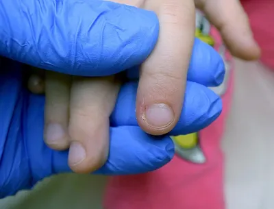 Ребёнок обгрызает ногти и заусенцы до крови: почему он это делает и как его  отучить | Мел