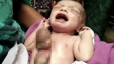 В Индии родился младенец с сердцем наружу