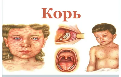 Корь - Педиатрия - Справочник MSD Профессиональная версия