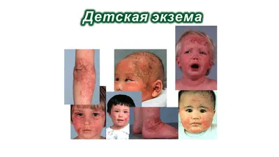 Названы причины и методы лечения атопического дерматита у взрослых и детей:  Уход за собой: Забота о себе: Lenta.ru