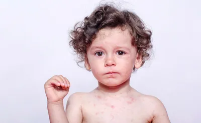 Детские инфекции: краснуха – в чем ее причины, как проявляется и как ее  нужно лечить | О детском здоровье: с врачебного на родительский | Дзен