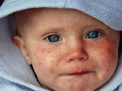 Краснуха — что это за болезнь, чем она опасна для детей и как ее лечить