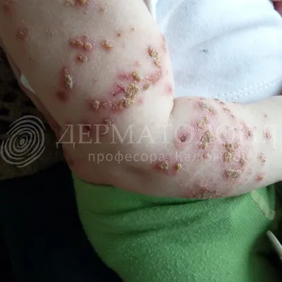 Детские заболевания кожи фото фото