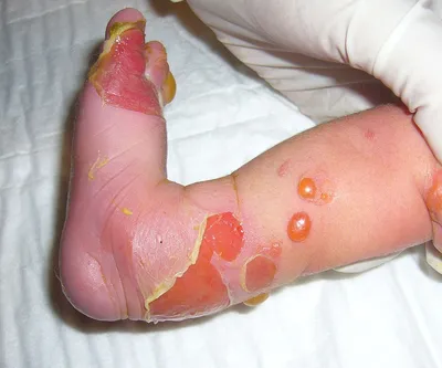 Виды дерматита, причины возникновения и общие симптомы | Балтмед