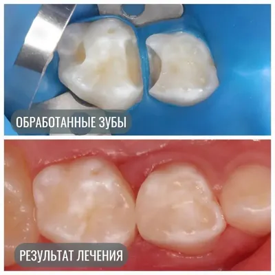 Какого цвета бывает кариес и когда он переходит в пульпит — делится  клиническим случаем стоматолог MagicKids