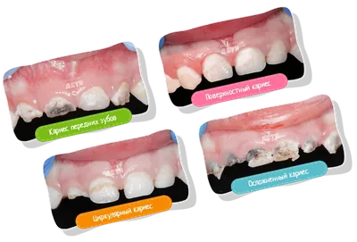 Обзор современных концепций лечения кариеса молочных зубов