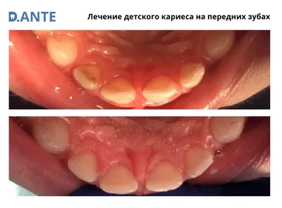 Больно ли лечить кариес с анестезией и без анестезии