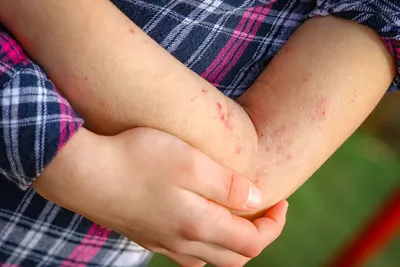 Атопический дерматит и другие проблемы кожи - МАЛІ Дитяча кліника