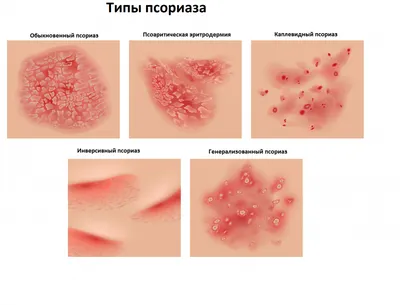 Псориаз волосистой части головы: причины, как выглядит, что делать, лечение