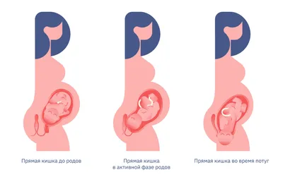 Правда ли, что во время родов можно обкакаться | Купрум