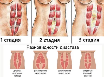 Причины и симптомы проявления диастаза живота - Исамутдинова Г. М.