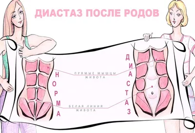 Диастаз прямых мышц