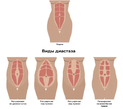 Устранение диастаза прямых мышц живота: лапароскопическая операция