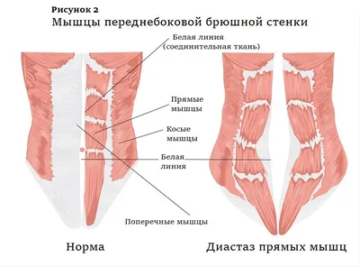 ЧЕМ ОПАСЕН ДИАСТАЗ ПРЯМЫХ МЫШЦ ЖИВОТА? | Руслан Беретарь | Дзен