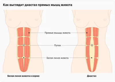 Лечение диастаза прямых мышц живота без разреза в Юсуповской больнице