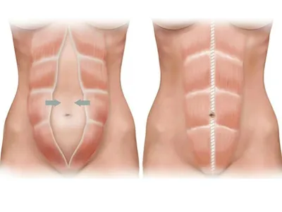 ТЕСТ НА ДИАСТАЗ ПРЯМЫХ МЫШЦ ЖИВОТА. Как определить диастаз после родов |...  | Диастаз прямых мышц живота, Тело после родов, Прямые мышцы живота