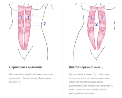 Когда нужна операция по ушиванию диастаза прямых мышц живота? -  Исамутдинова Г. М.