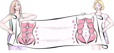 Фотогалерея \"Диастаз прямых мышц живота\" — Лечение грыжи живота, операция,  удаление грыжи в Киеве - Хирург Рейзин Денис