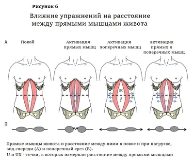 🏥 ✓Диастаз прямых мышц живота ⋆ 2024