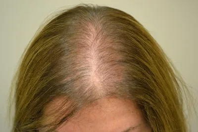 Диффузное выпадение волос фото фото
