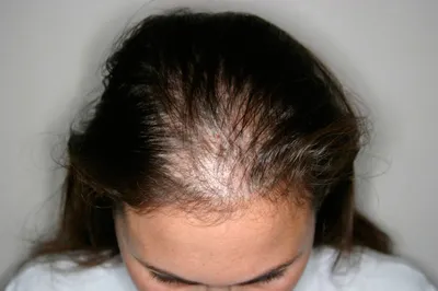 Лечение диффузного выпадения волос - Центр европейской дерматологии