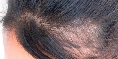 Результати лечения волос До и После | Medic Hair