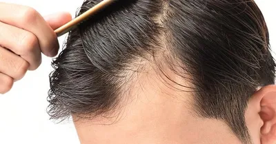DSD de Luxe - Диффузное телогеновое выпадение волос - самая частая причина  потери волос. Это не конкретный диагноз, а сборное понятие, так как имеет  различные причины. ⠀ О факторах данного вида алопеции