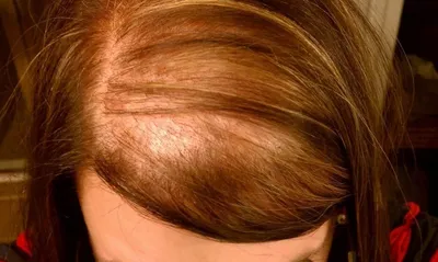 Быстрое восстановление волосяного фолликула, лечение роста волос,  себорореевая алопеция, Послеродовая выпадение волос вверх, облысение, выпадение  волос | AliExpress