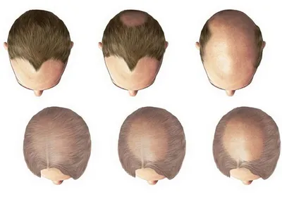 Диффузное выпадение волос: лечение диффузного выпадения волос у женщин