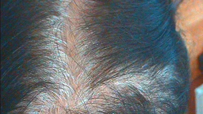 Существует ли связь между андрогенной алопецией и диффузным выпадением волос ?
