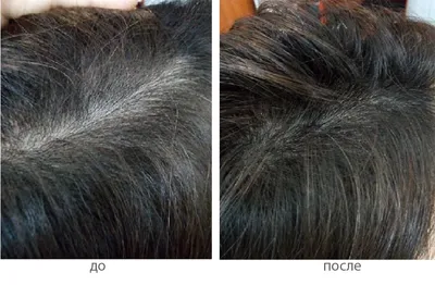 Ампулы для волос L'Oreal Professionnel Aminexil Advanced (Serie Expert) -  «🔥Моя борьба с выпадением волос. Использую L'Oreal Professionnel Aminexil  Advanced при диффузной алопеции на фоне стресса и при нарушении работы  щитовидки. Главное -