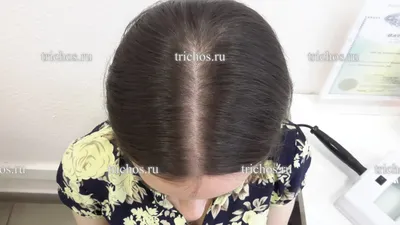 Диффузное выпадение волос: причины и способы лечения