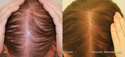 Выпадение волос у женщин. Причины, лечение волос у женщин