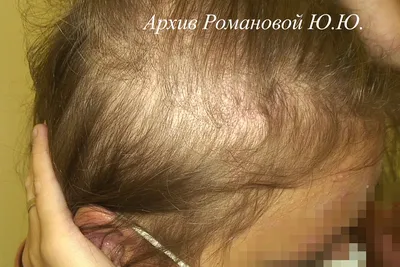 Острое телогеновое выпадение волос после COVID-19. Случай из практики. -  BEPHARM