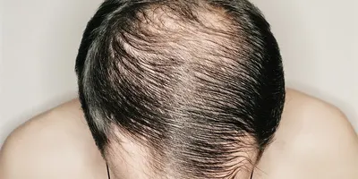 Лечение выпадения волос у женщин в Москве: цены, фото до и после, отзывы |  Стоимость лечения выпадения волос у женщин в клинике Seline