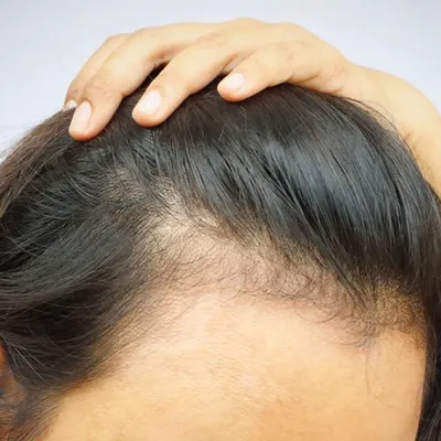 После коронавируса выпадают волосы: что делать, чем лечить – советы  трихологов | Beauty Insider